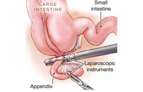  Laparoscopic Appendix Surgery in Nanded